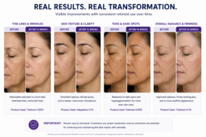 Before and after retinoid treatment showing wrinkle reduction and improved skin texture" "Patient results after 12 weeks of tretinoin retinoid therapy demonstrating anti-aging benefits